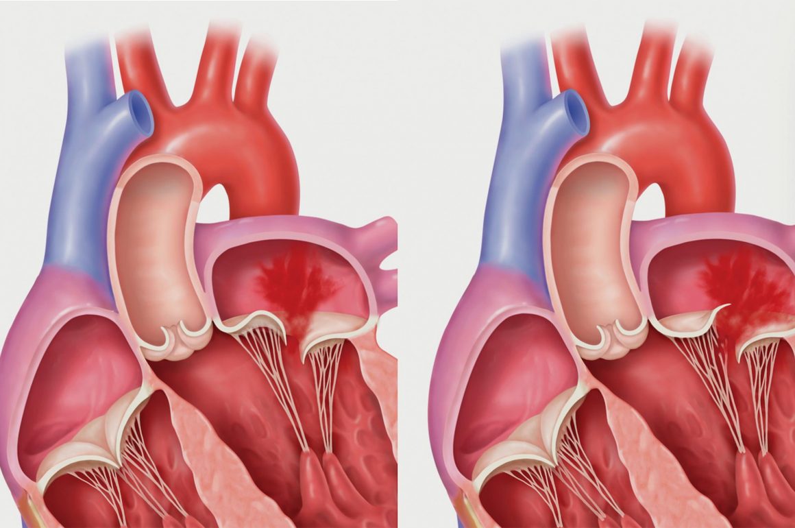 How Can You Solve Mitral Insufficiency Susan Philmar